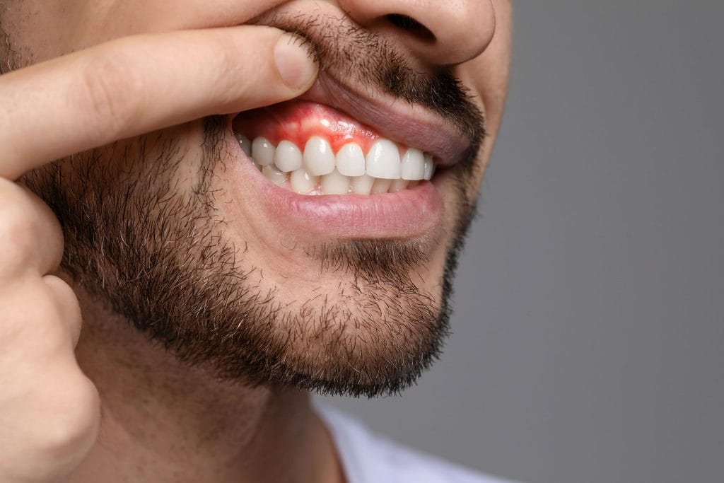 Understanding Dental Abscesses