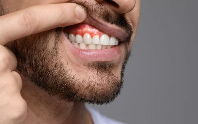 Understanding Dental Abscesses