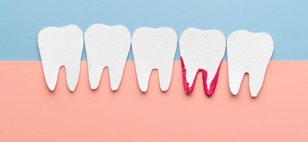 When Bleeding Gums Become a Dental Emergency