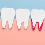 A row of five stylized white tooth cutouts on a pastel blue and pink background. The fourth tooth has a pink area at its base, symbolizing gum inflammation or gum disease, contrasting with the other clean and healthy-looking teeth.